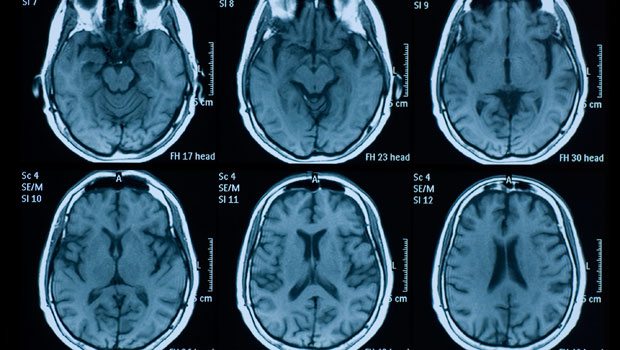 Transseksüel gencin beyin MR’ı doktorları şaşırttı
